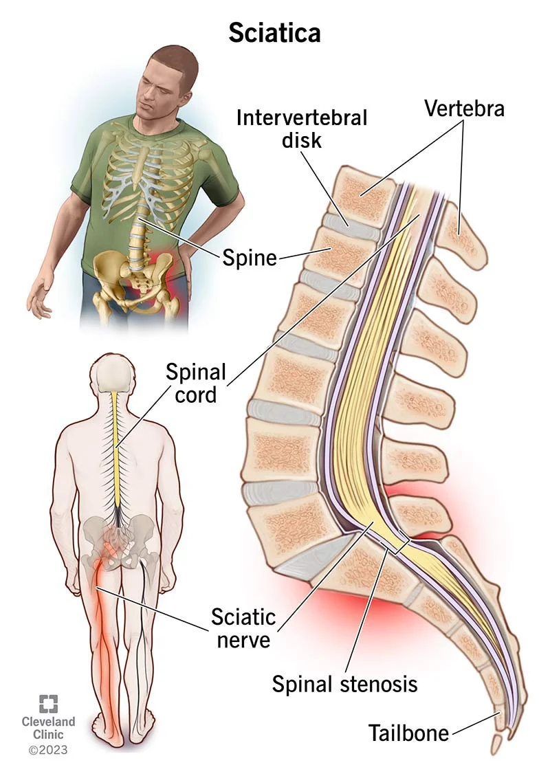 Ayurveda Therapy for Sciatica